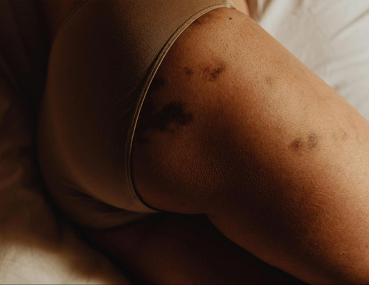 Pad Rash During Periods: Causes, Symptoms & How to Treat It Fast