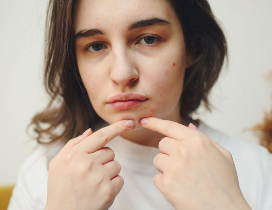 Period Acne: Why Do You Get Pimples Before Your Period?